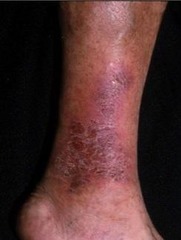 Stasis Dermatitis:  Manage the edema!!! Topical Corticosteroids  Wet compresses-Domeboro for oozing & crusting  Be concerned about the development of ulcers  (Marlin D&E Lecture PP37;38)