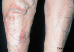 Stasis eczema