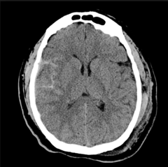 Subarachnoid hemorrhage Dx on CT
