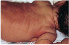 subcutaneous fat necrosis of the newborn hypercalcemia