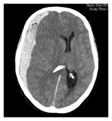 Subdural Hematoma Dx: