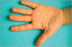 Superficial desquamation after toxic erythema.