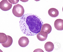 T cell large granular lymphocytic leukemia (LGL)