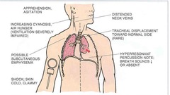 Tension Pneumothorax  - what is it and what might it cause?