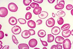 Thalassemia.  Varying degrees.  Tx w/ transfusion & deferoxamine. Can see expanded medullary space