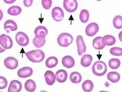 Thalassemia RDW - little variation, suggests genetic cause