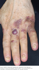 The lesion was originally mistaken for a bruise as were similar lesions on the feet and on the other hand.   Fitzpatrick's 7e FIGURE 21-16