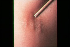 This test is positive when you rub your patients skin and a brown lesion of urticaria appears and is palpable. Dermatographism Diascopy Hair Pull Darier's Sign Nikolsky's Sign