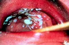 Thrush on the Palate (Candidiasis)  Thrush is a yeast infection from Candida species. Shown here on the palate, it may appear elsewhere in the mouth (see p. 289).   Thick, white plaques are somewhat adherent to the underlying mucosa.  Bates pg 285