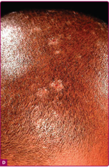 Tinea Capitis: Dermatophyte infection   The alopecic patches usually show signs of inflammation and scaling with brittle grayish hair stumps    Fitzpatrick's Figure 88-22