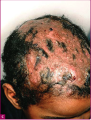 Tinea Capitis: Dermatophyte infection  To establish a diagnosis, hair shafts should be plugged out and cultured, as well as examined after KOH preparation.  Fitzpatrick's Figure 88-22