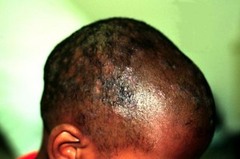 Tinea capitis  Keys: elderly, African American, barber, black dots. Usually an unclean razor