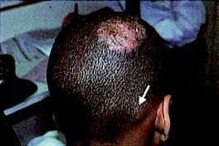 Tinea Capitis  Scaling, crusting, and hair loss are seen in the scalp, along with a painful plaque (kerion) and occipital lymph node (arrow).  Bates pg 880