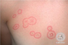 Tinea corporis (ringworm)