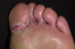 Tinea pedis  Can also see vesicles, nail thickening