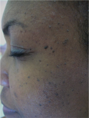 tiny SK's on darker skin types in cheeks and temples?