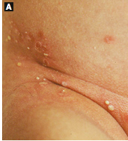 Transient Neonatal Pustular Melanosis; PMN; subcorneal pustule with PMNS