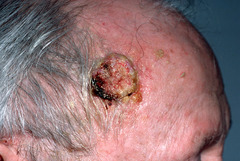 treat precursor lesions (actinic keratosis or keratoacanthoma) Txt: Excisional bx at edge of lesion, then wide local excision. Can use rads for tough locations.