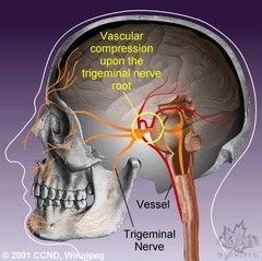 Trigeminal neuralgia