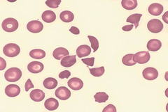 TTP/HUS Causes: O157:H7, Ticlopidene Txt: plasmapheresis, NOT platelets