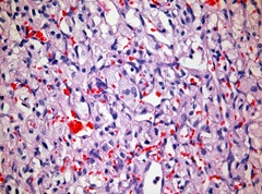 typical microscopic findings of hemangioblastoma
