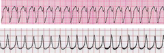 Ventricular tachycardia  Unstable pt: cardiovert Stable pt: Lidocaine, Amiodarone