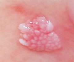 Verruciform xanthoma; NOT associated with hyperlipidemia; ass with CHILD syndrome and any disorder that causes epidermal damage (ie. EB, GVHD, LS&A, pemphigus)