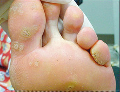 Verrucus vulgaris (plantar warts)  Keys: wt bearing parts of feet, verrucous appearance, disruption of nl skin lines