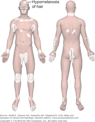 Vitiligo: predilection sites.  Fitzpatrick's Figure 13-4