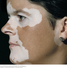 Vitiligo  Topical calcineurin inhibitors: Tacrolimus and pimecrolimus. They are reported to be most effective when combined with UVB or excimer laser therapy.  Fitzpatrick's Figure 13-2