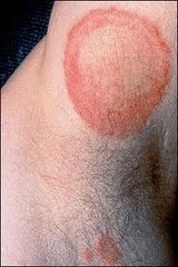 what are Dermatophytoses