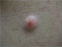 what are epidermal inclusion cysts?