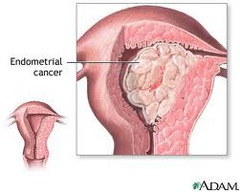 What are the risk factors for Endometrial Carcinoma (cancer or Uterine lining)?