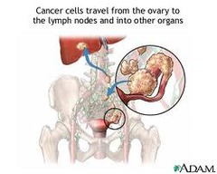 What are the risk factors for Ovarian Cancer?