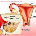 What are the S/S of Ovarian Cancer?