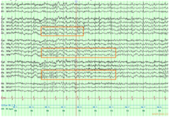 What does normal EEG look like?