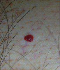 what is a cherry angioma?