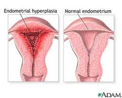 What is a simple (cystic) hyperplasia?