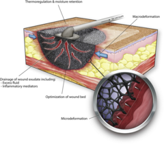 What is a wound vac?