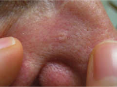 what is sebaceous hyperplasia?