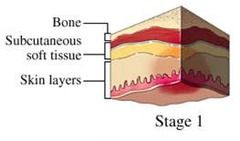 What is Stage I of a Pressure Ulcer?