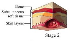 What is Stage II of a Pressure Ulcer?