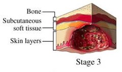 What is Stage III of a Pressure Ulcer?