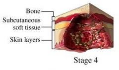 What is Stage IV of a Pressure Ulcer?