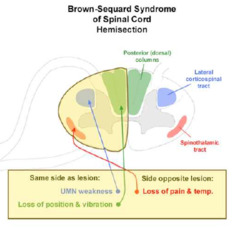 What is the result of damage to the lateral spinothalamic tracts?