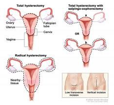 What is the Tx for Endometrial Cancer?