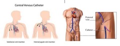 Where is the double-lumen central venous catheter inserted?