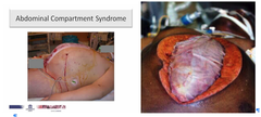 abdominal compartment syndrome