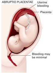 abrupto placenta