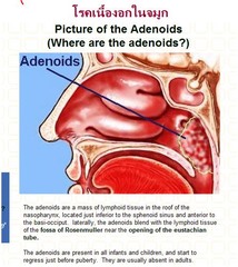 adenoid/o